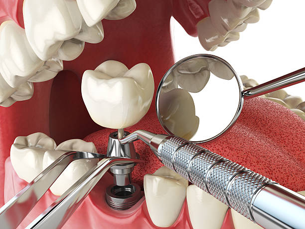 Best Emergency Root Canal Treatment in Lake Lifornia, CA