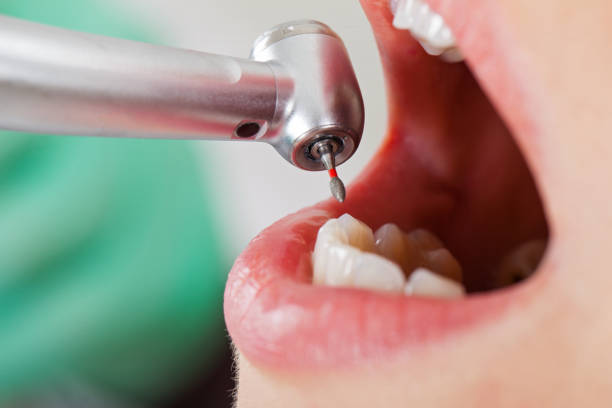 Best Emergency Dental Care for Abscessed Tooth in Lake Lifornia, CA